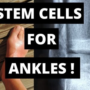 Stem Cell Therapy For Ankle Pain And Arthritis