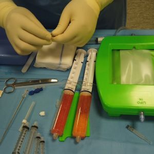 LIPO-STEM SURGICAL SESSION: Adipose-Derived Mesenchymal Stem Cells injection in knee osteoarthritis
