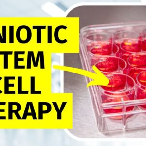 Amniotic Stem Cell Therapy for Knee Arthritis